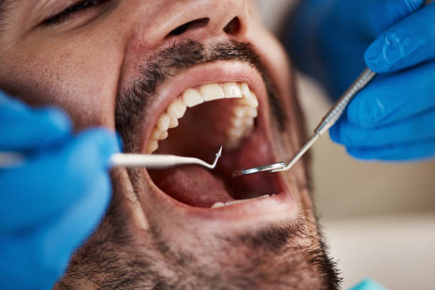 Best Chipped Tooth Repair Near Me  in Bethany, MO